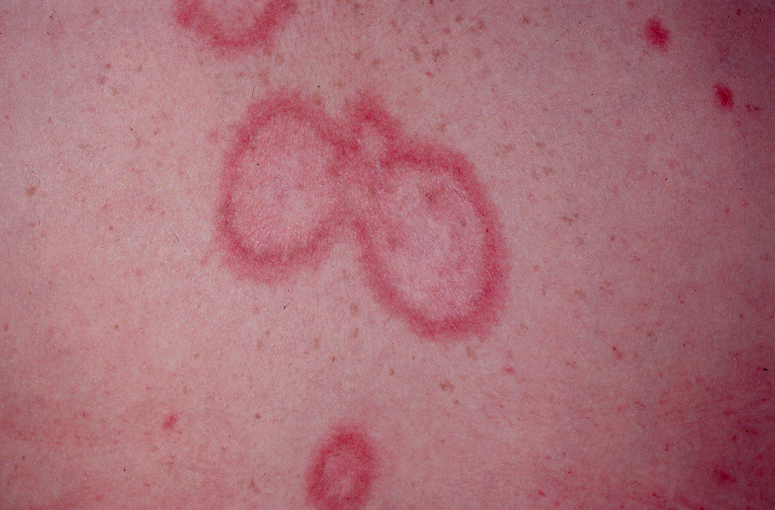 lupus